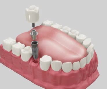 dentalimplants7 - SmilePro Dental